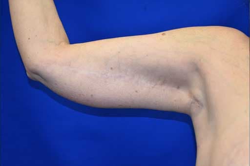 Brachioplasty
