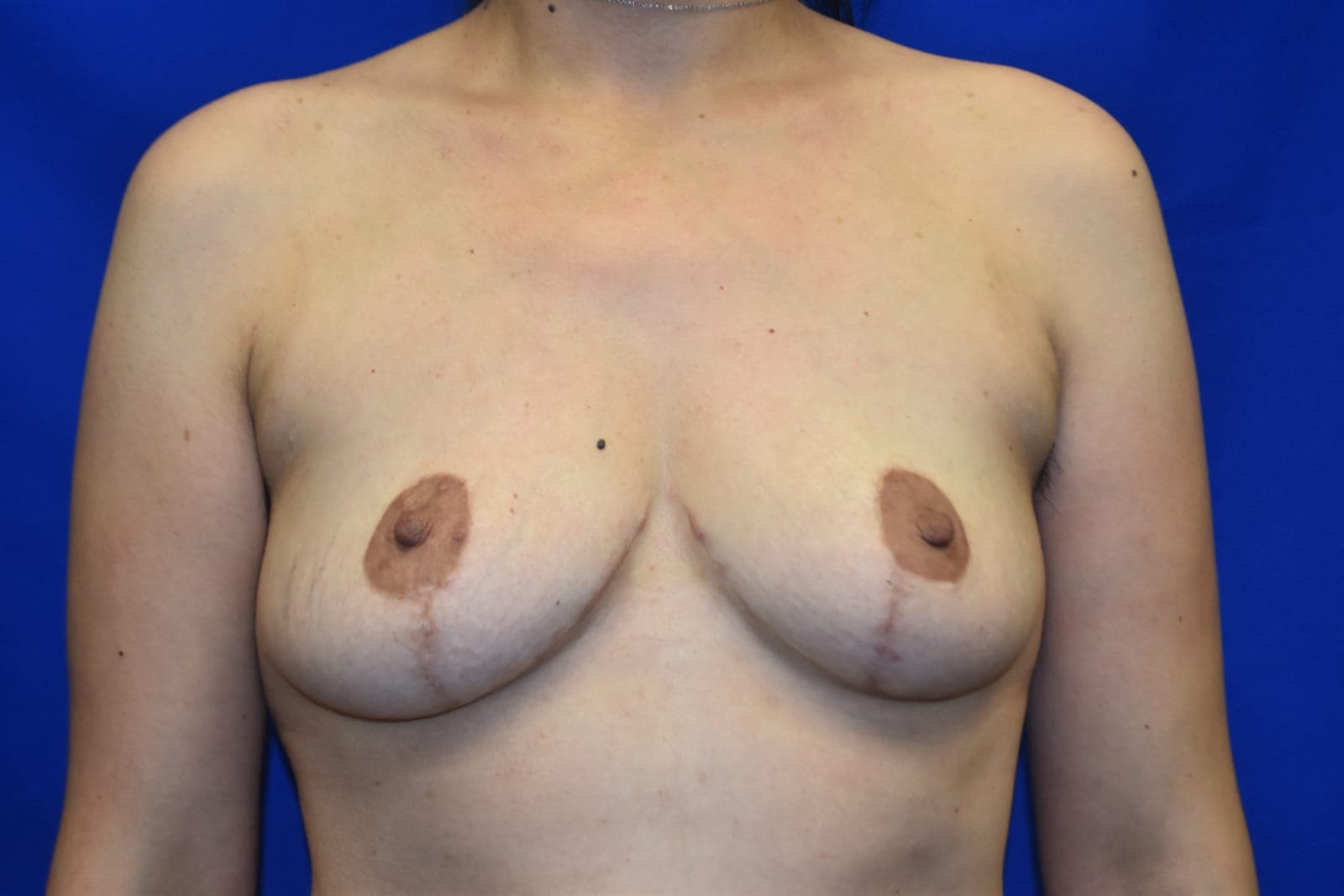 Breast Lift