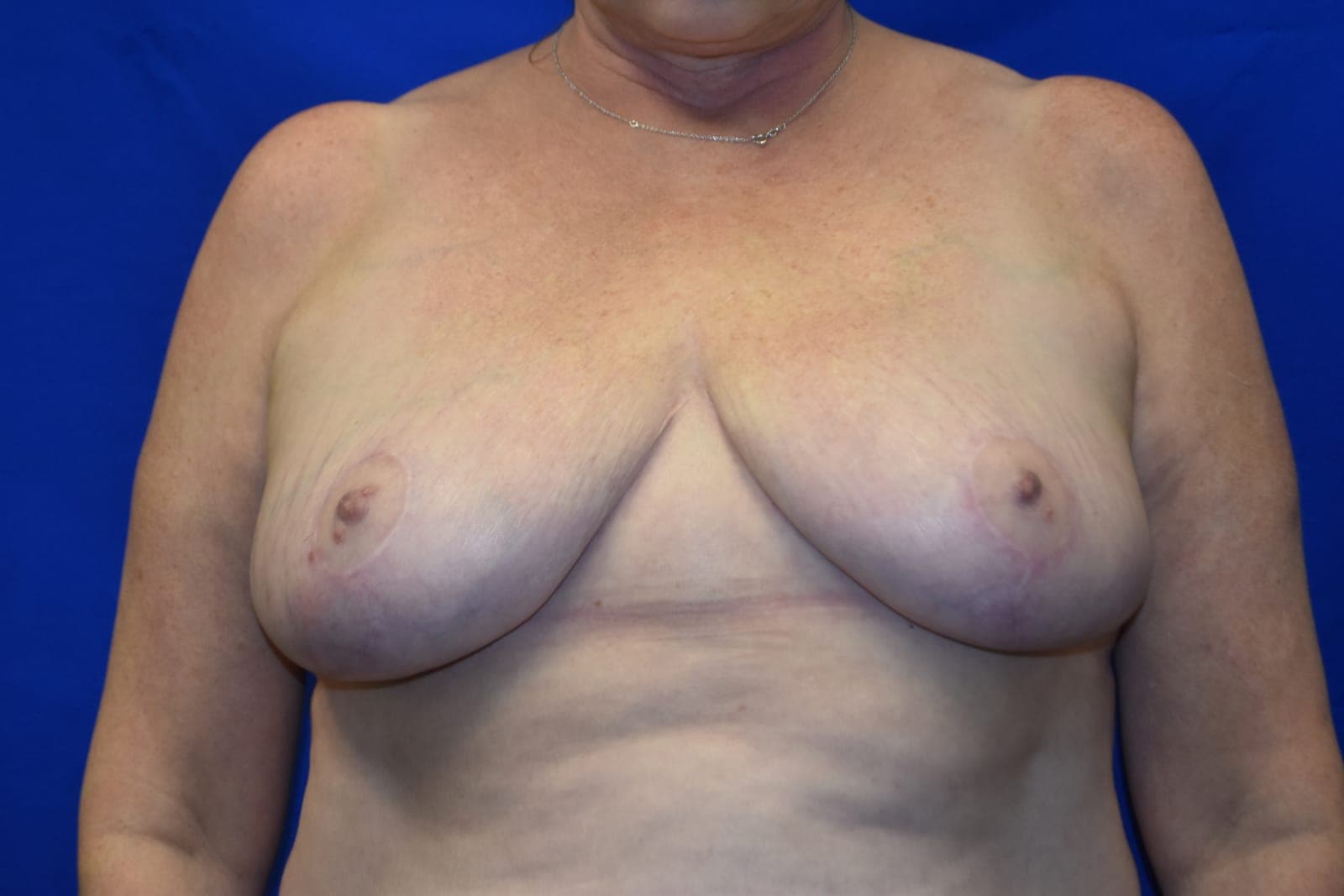 Breast Reduction