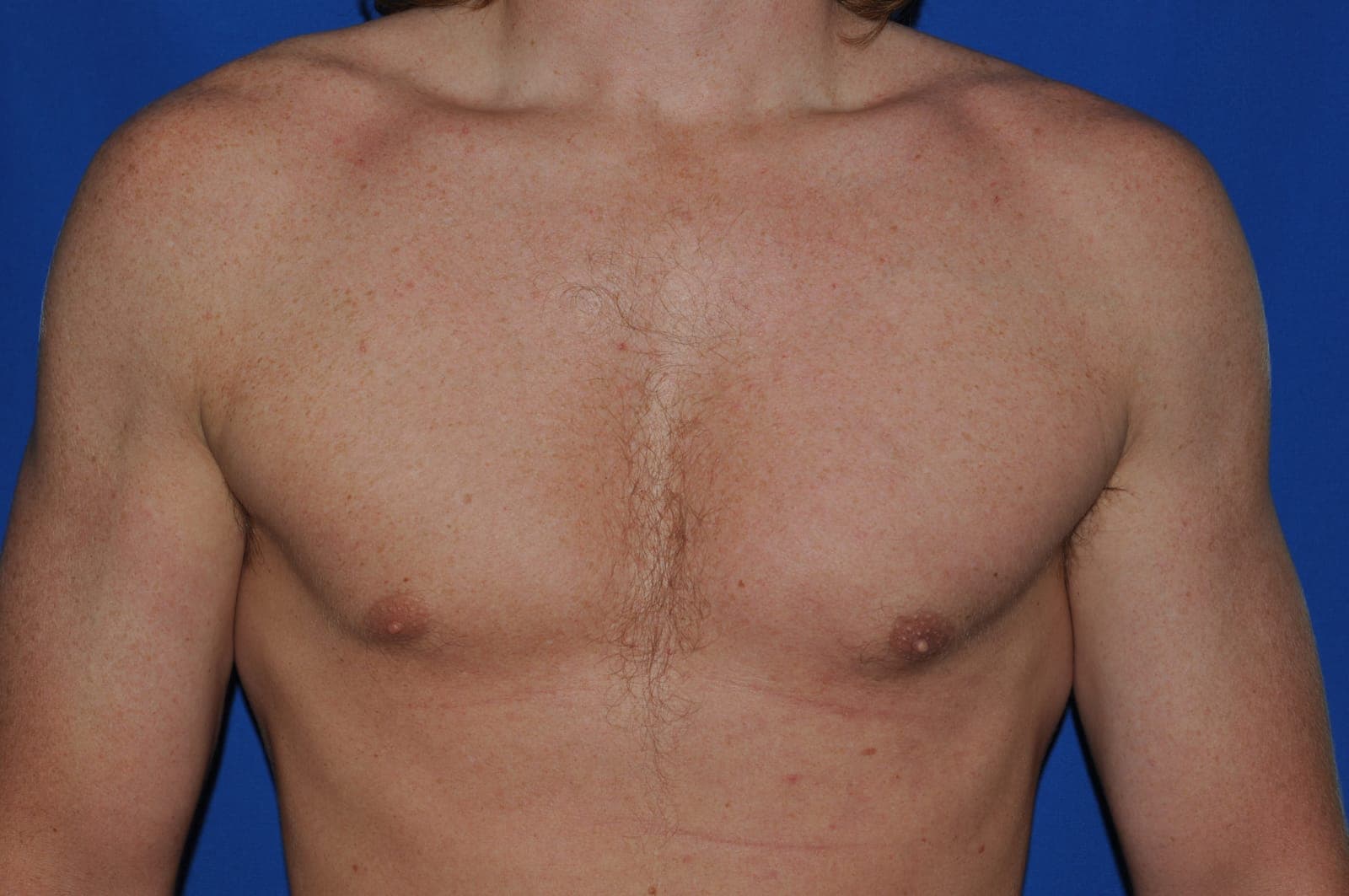 Gynecomastia