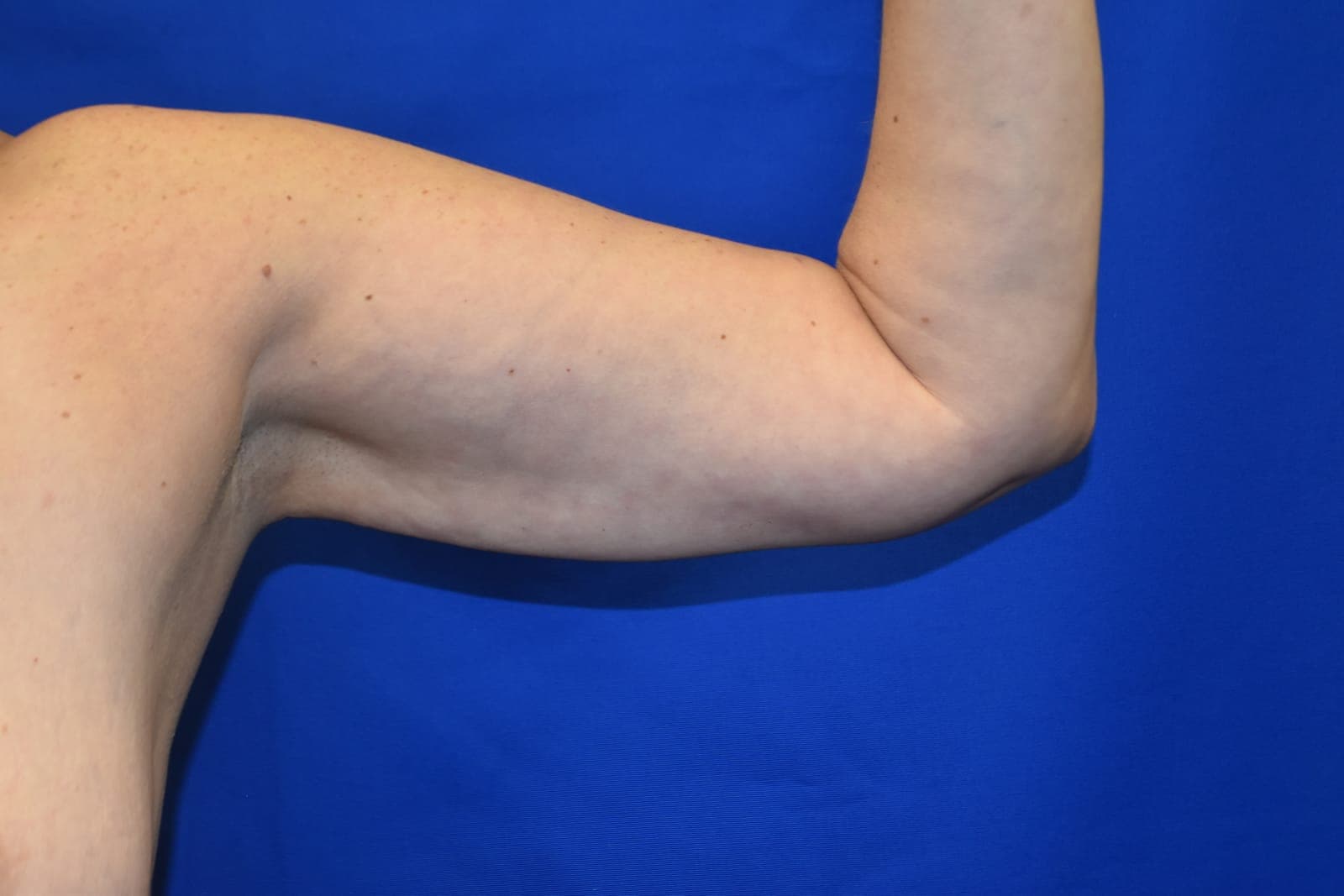 Liposuction