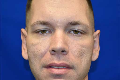Otoplasty