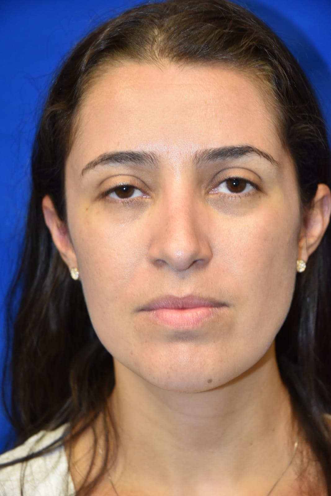 Rhinoplasty