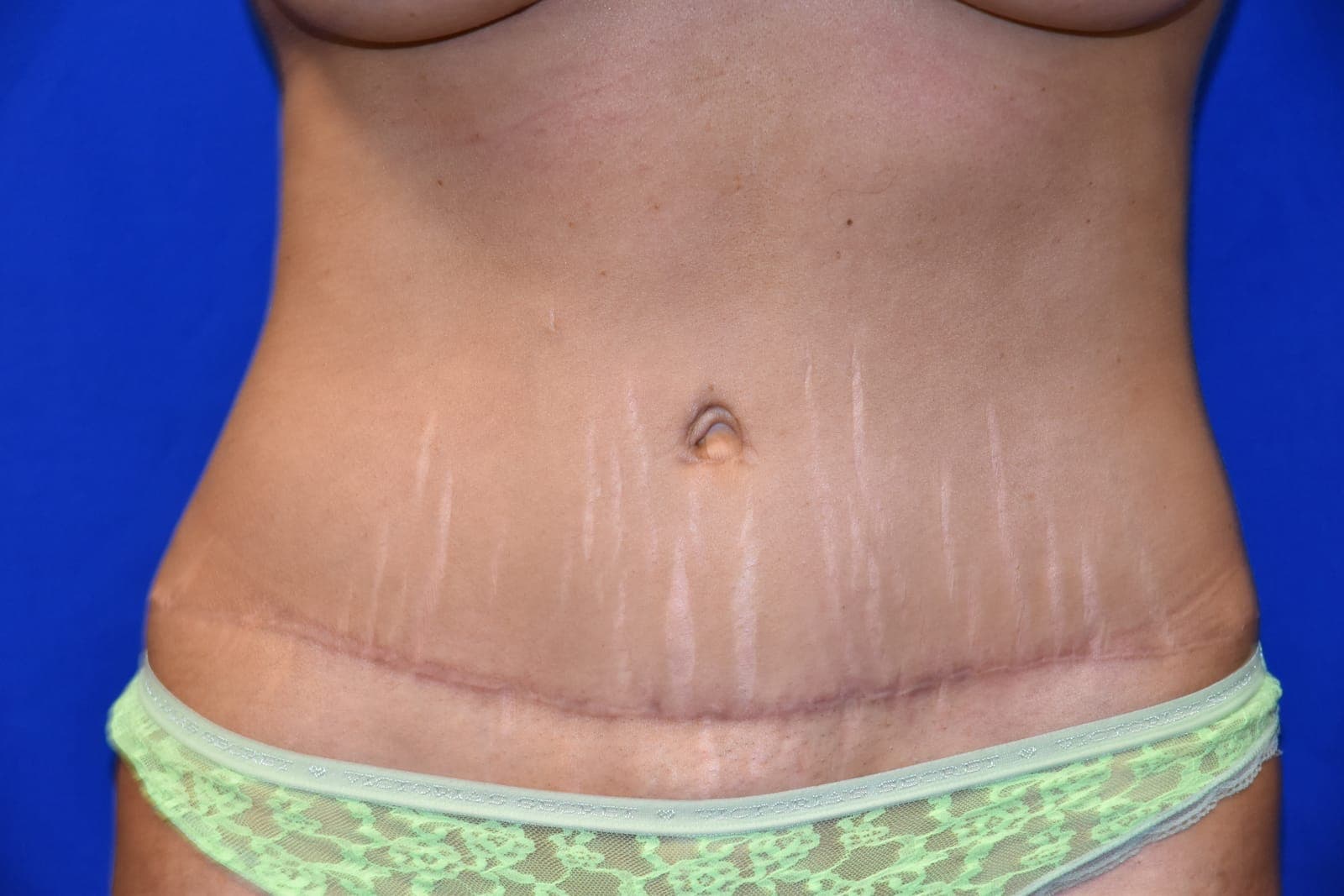 Tummy Tuck