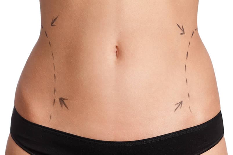Liposuction