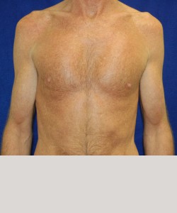 Case 1 Bicep Augmentation - Front view