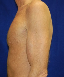 Case 1 Bicep Augmentation - Side view