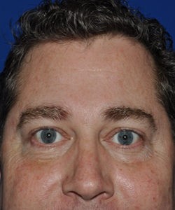 Case 9 Lower Blepharoplasty - Front view