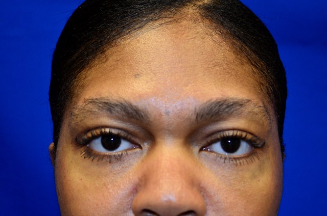 Case 8 Upper & Lower Blepharoplasty - Front view