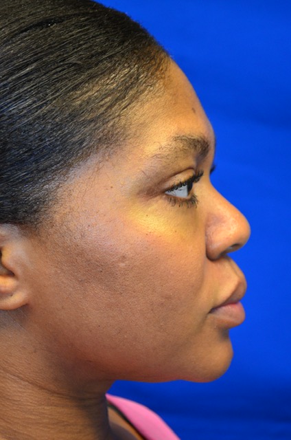 Case 8 Upper & Lower Blepharoplasty - Right profile