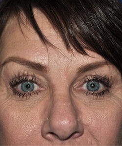 Case 1 Upper Blepharoplasty - Front view