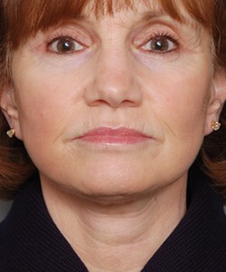 Case 10 Upper Blepharoplasty - Angle 1