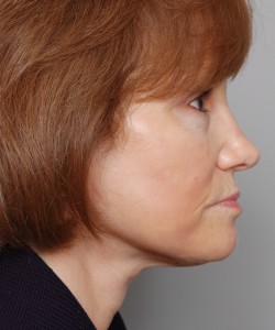 Case 10 Upper Blepharoplasty - Angle 2