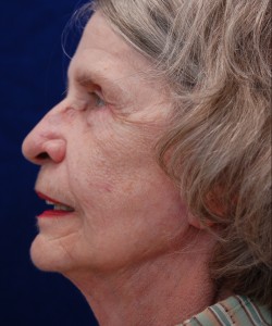 Case 7 Upper Blepharoplasty - Angle 2