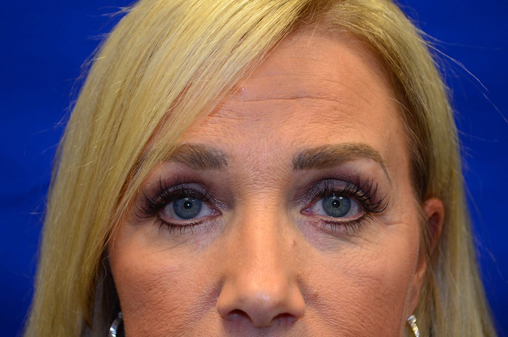 Case 5 Upper Blepharoplasty - Front view