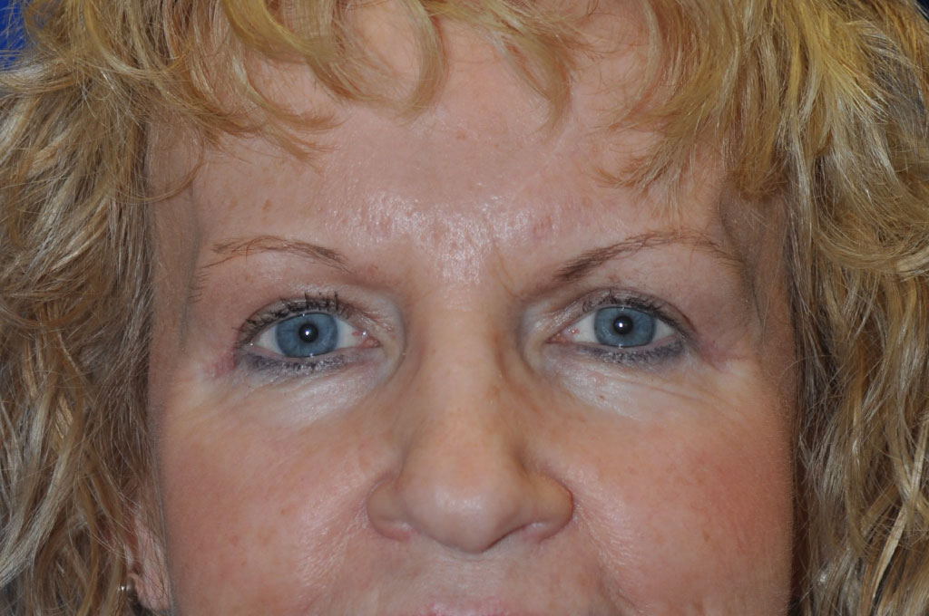 Case 6 Upper Blepharoplasty - Front view