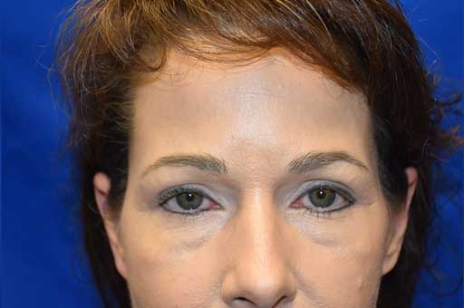 Case 3 Upper Blepharoplasty - Close-up view