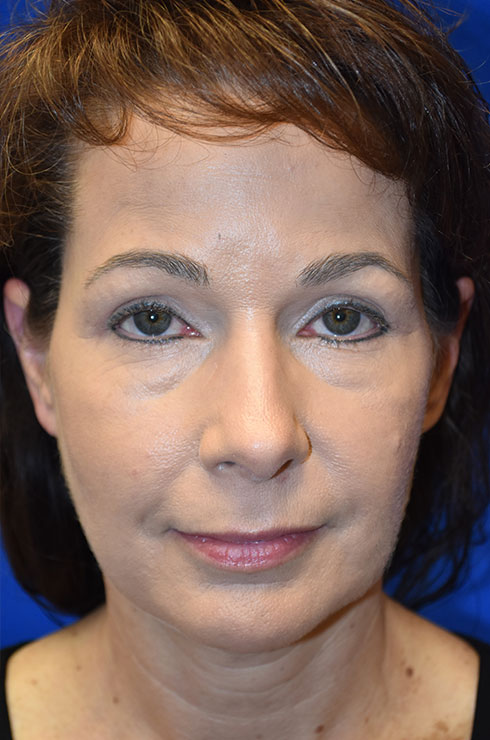 Case 3 Upper Blepharoplasty - Full face view