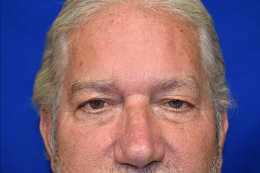 Case 4 Upper Blepharoplasty - Close-up view