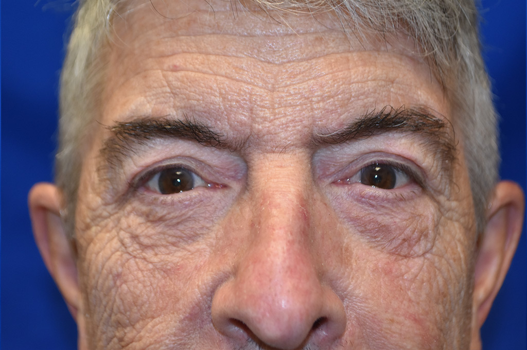 Case 2 Upper & Lower Blepharoplasty - Front view