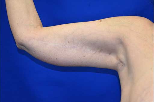 Case 1 Brachioplasty - Right arm