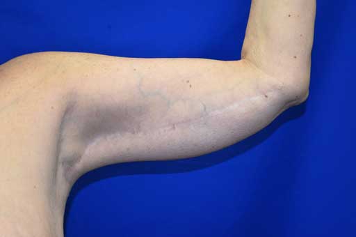 Case 1 Brachioplasty - Left arm