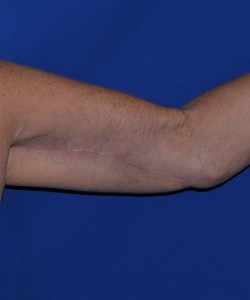 Case 2 Brachioplasty - Front view