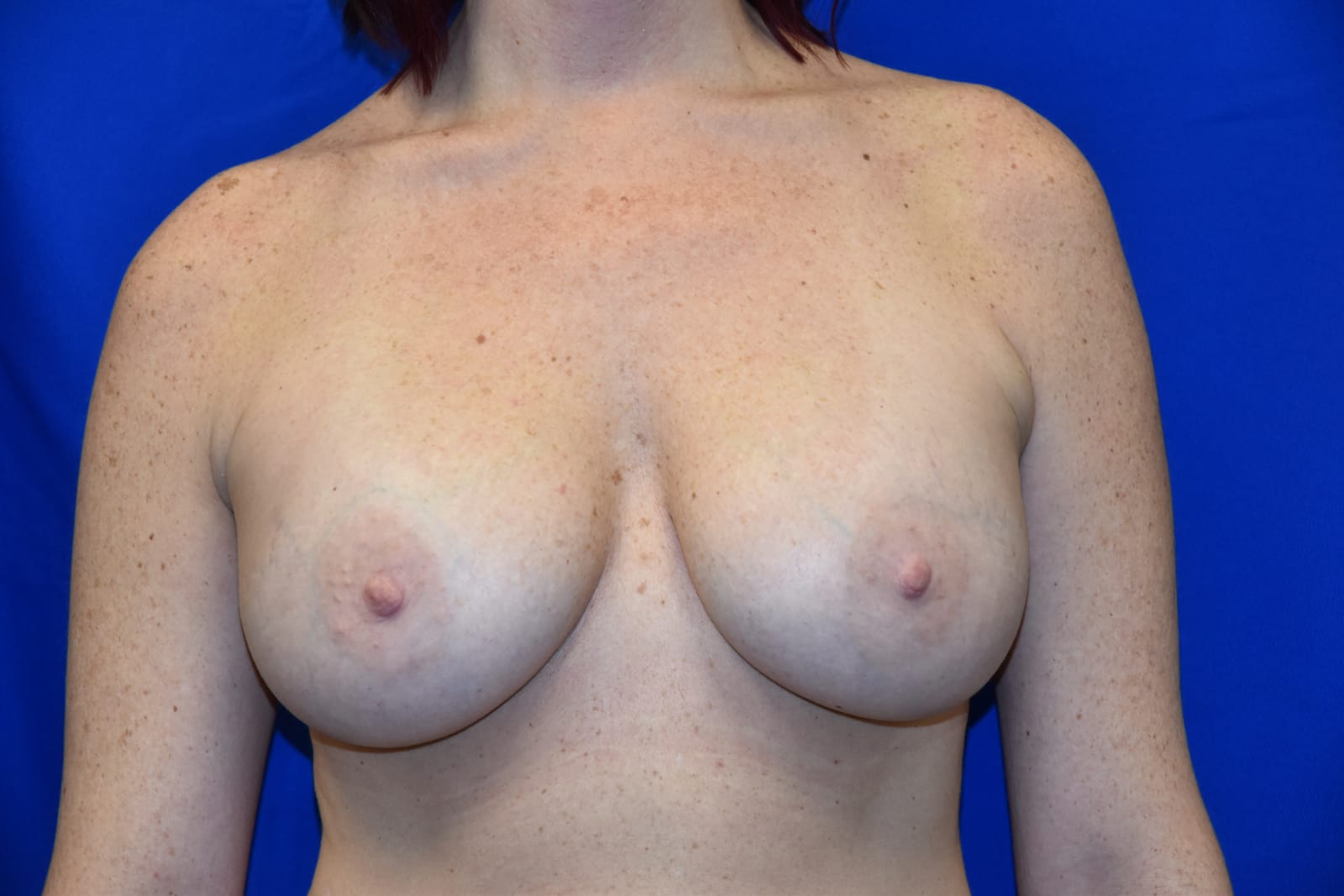 Case 1 — 450cc Breast Augmentation - Front view