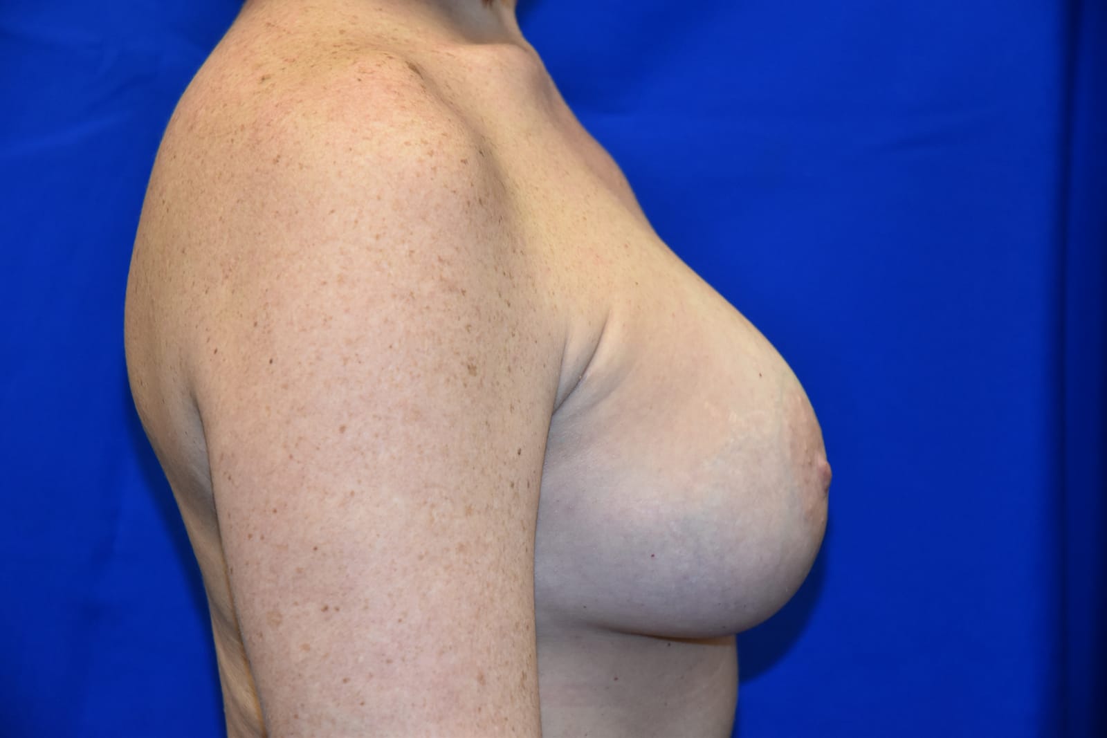 Case 1 — 450cc Breast Augmentation - Lateral view