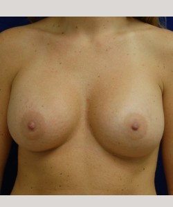 Case 10 — 300cc Breast Augmentation - Front view