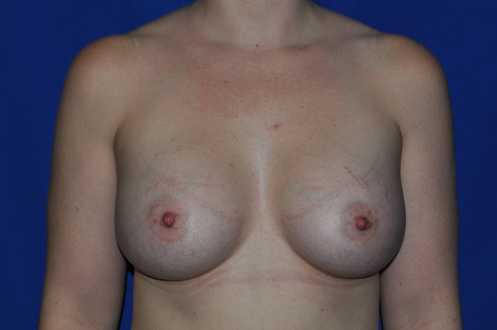 Case 13 — 300cc Breast Augmentation - Front view