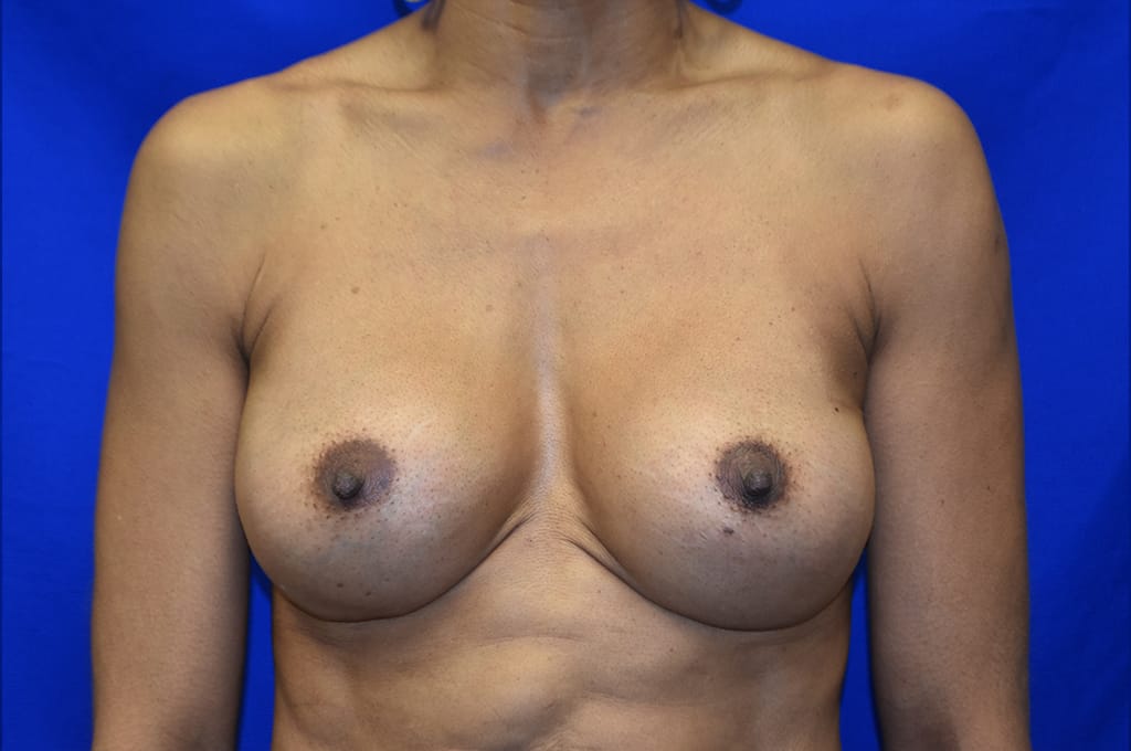 Case 14 — 300cc Breast Augmentation - Front view