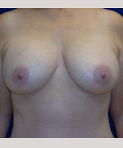 Case 17 — 400cc Breast Augmentation - Front view