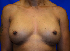 Case 18 — 400cc Breast Augmentation - Front view