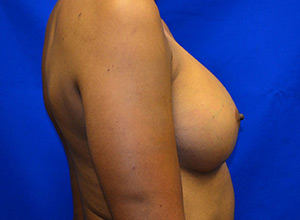 Case 18 — 400cc Breast Augmentation - Lateral view