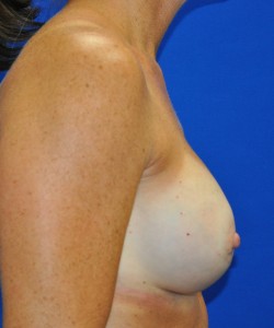 Case 22 — 325cc Breast Augmentation - Right lateral