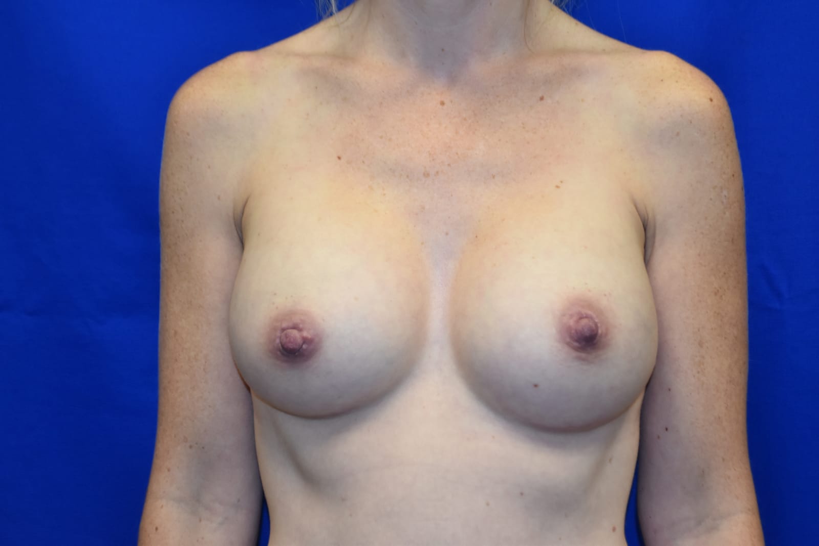 Case 6 — 400cc Breast Augmentation - Front view