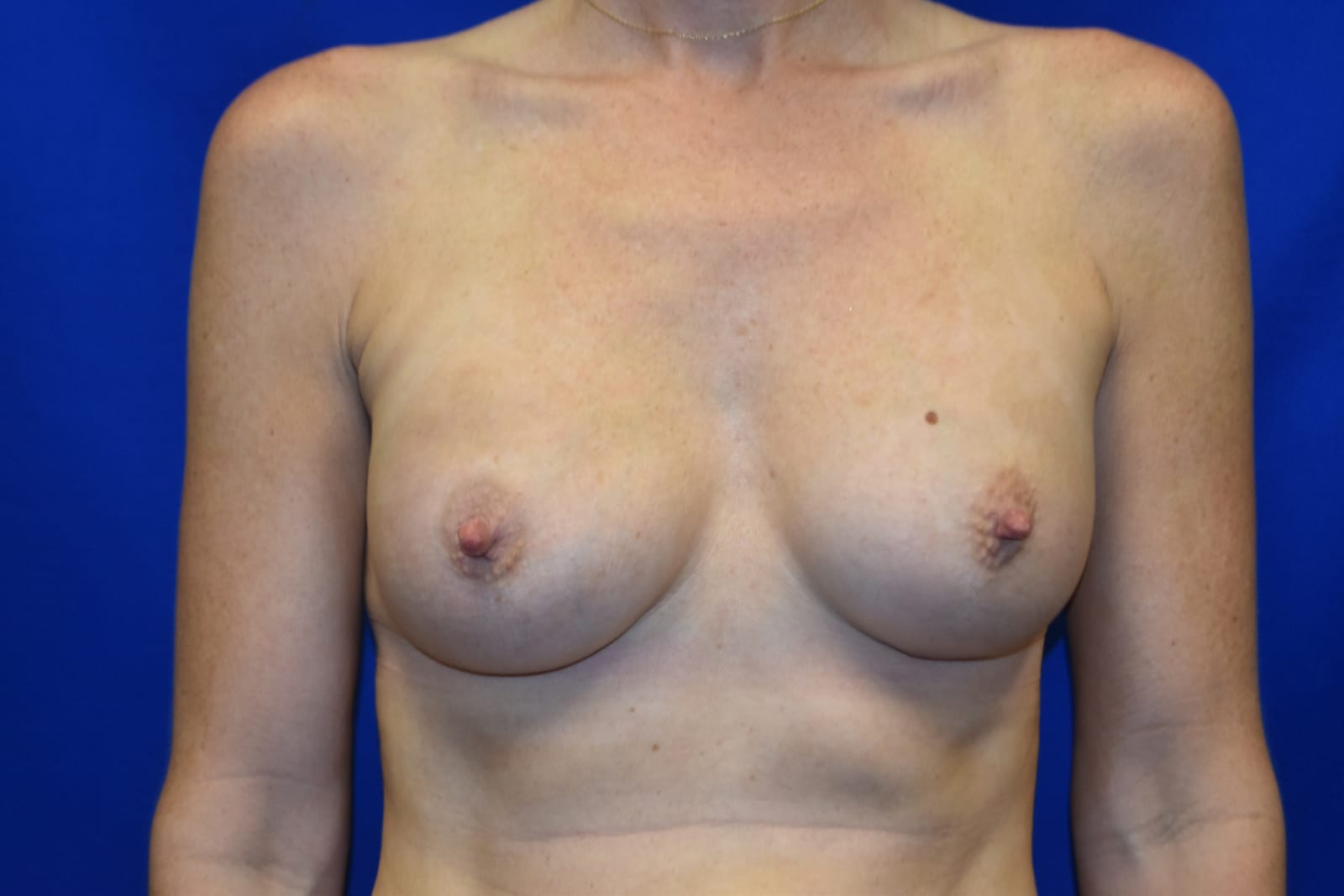 Case 7 — 300cc Breast Augmentation - Front view