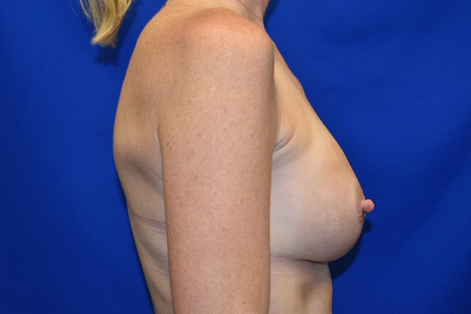 Case 7 — 300cc Breast Augmentation - Right lateral