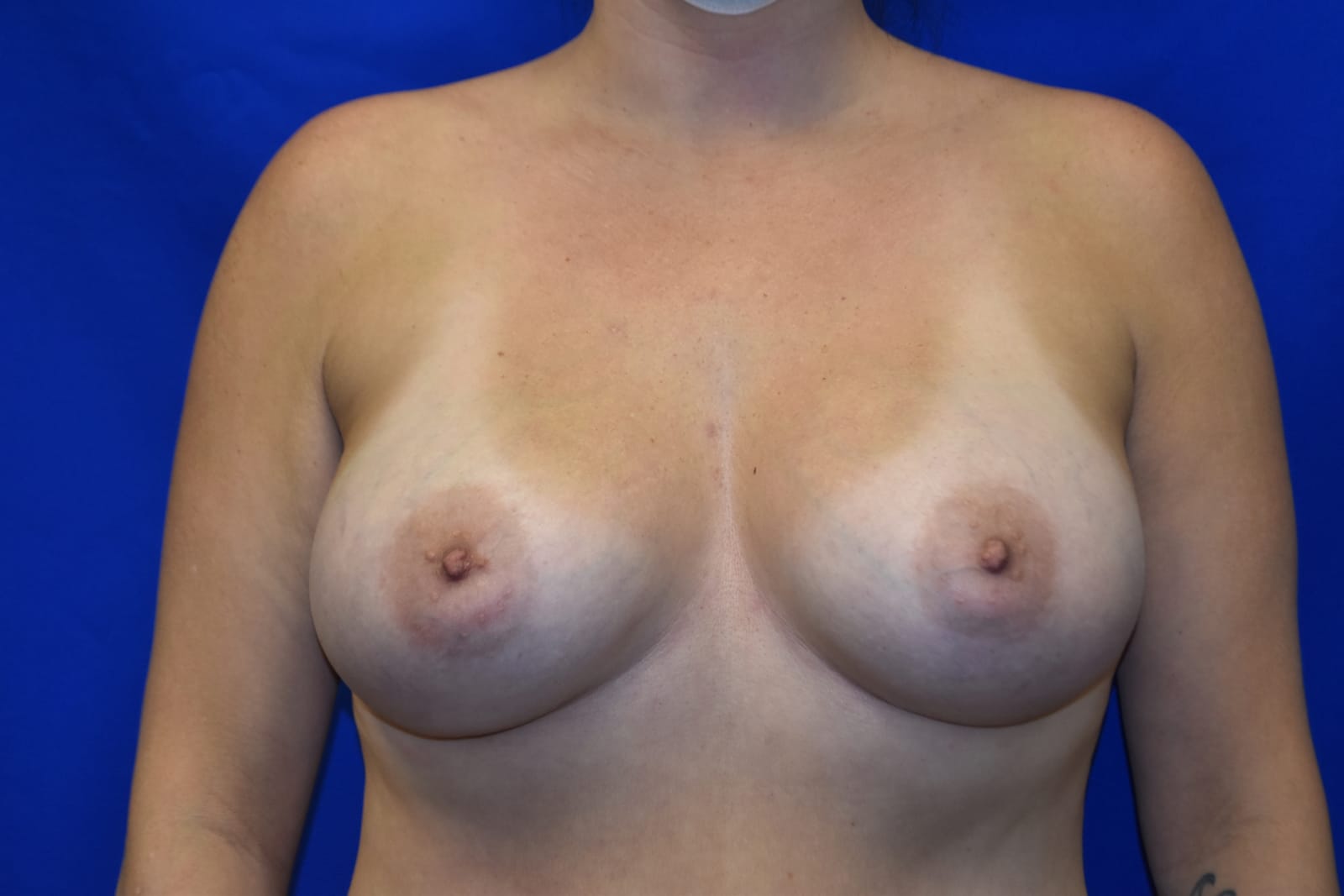Case 9 — 300cc Breast Augmentation - Front view