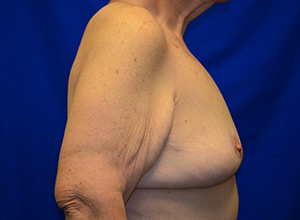 Case 3 Breast Lift - Side view
