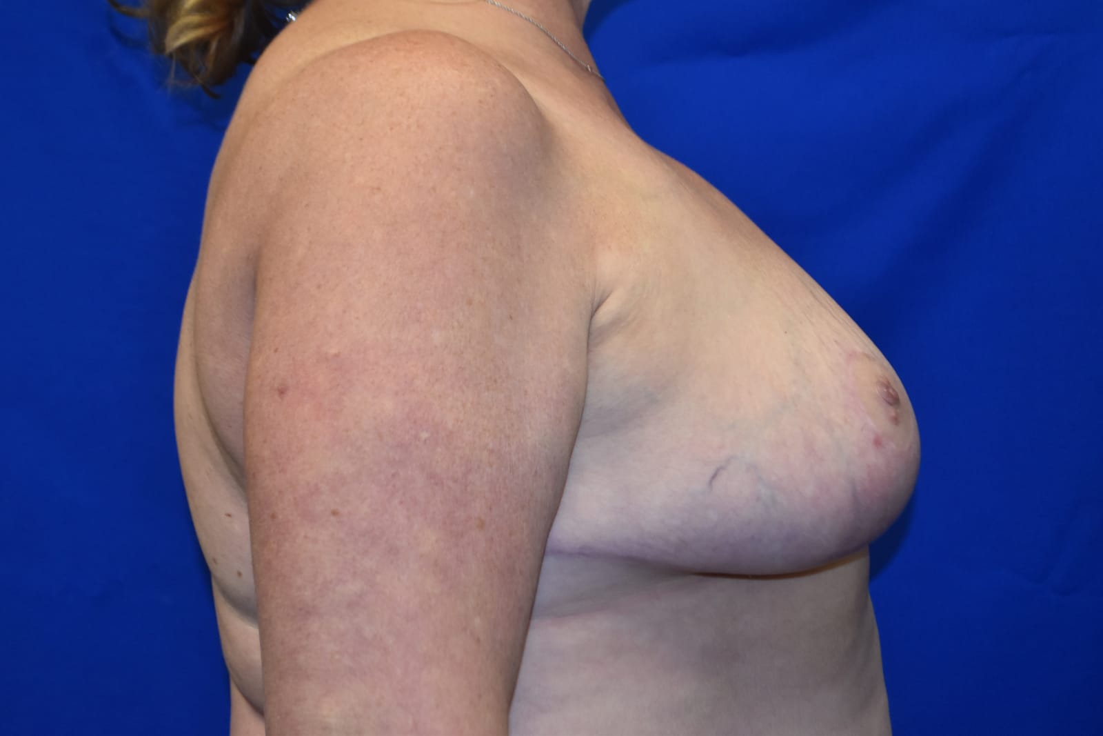 Case 1 Breast Reduction - Lateral view