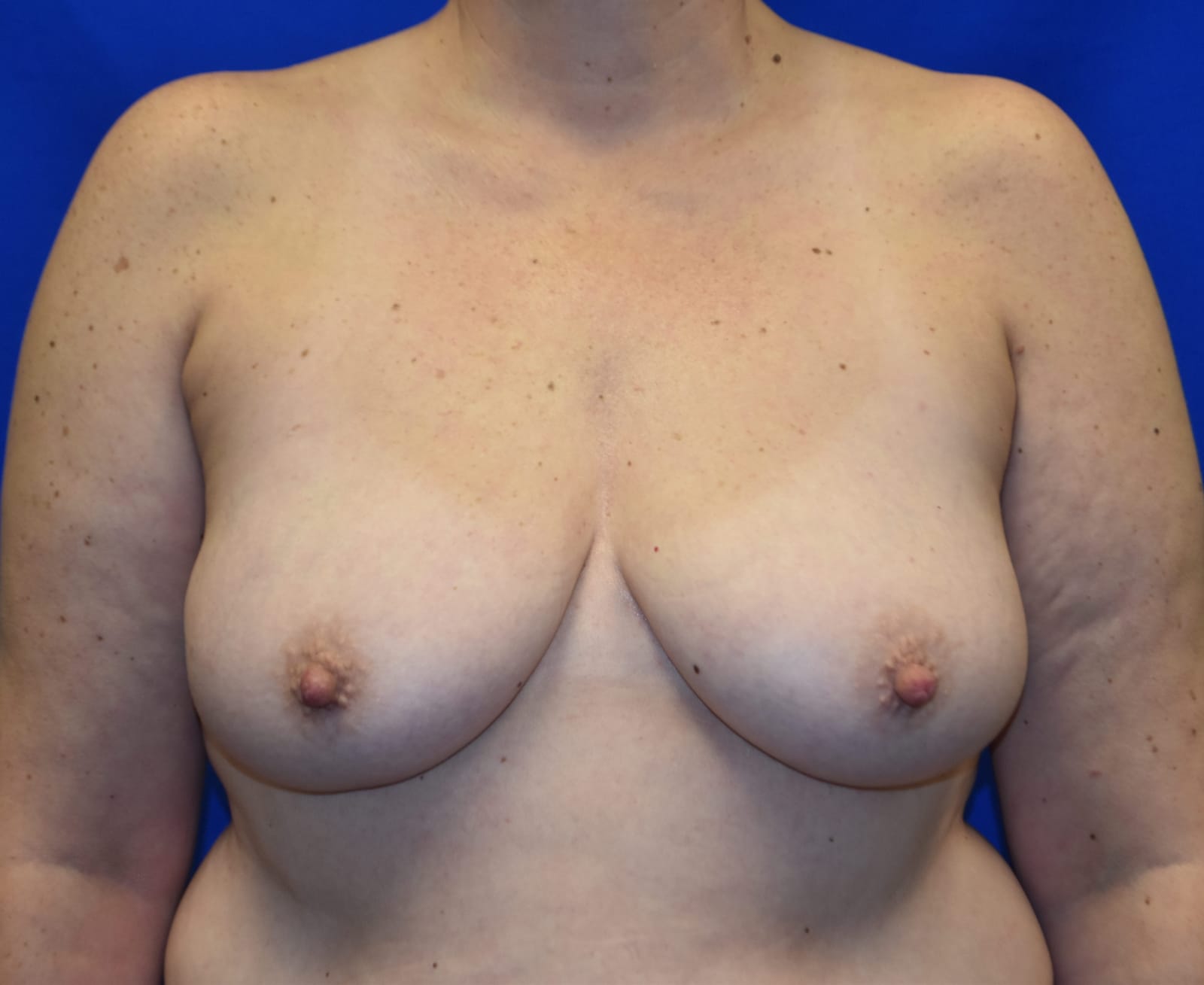 Case 2 Breast Reduction - Front view