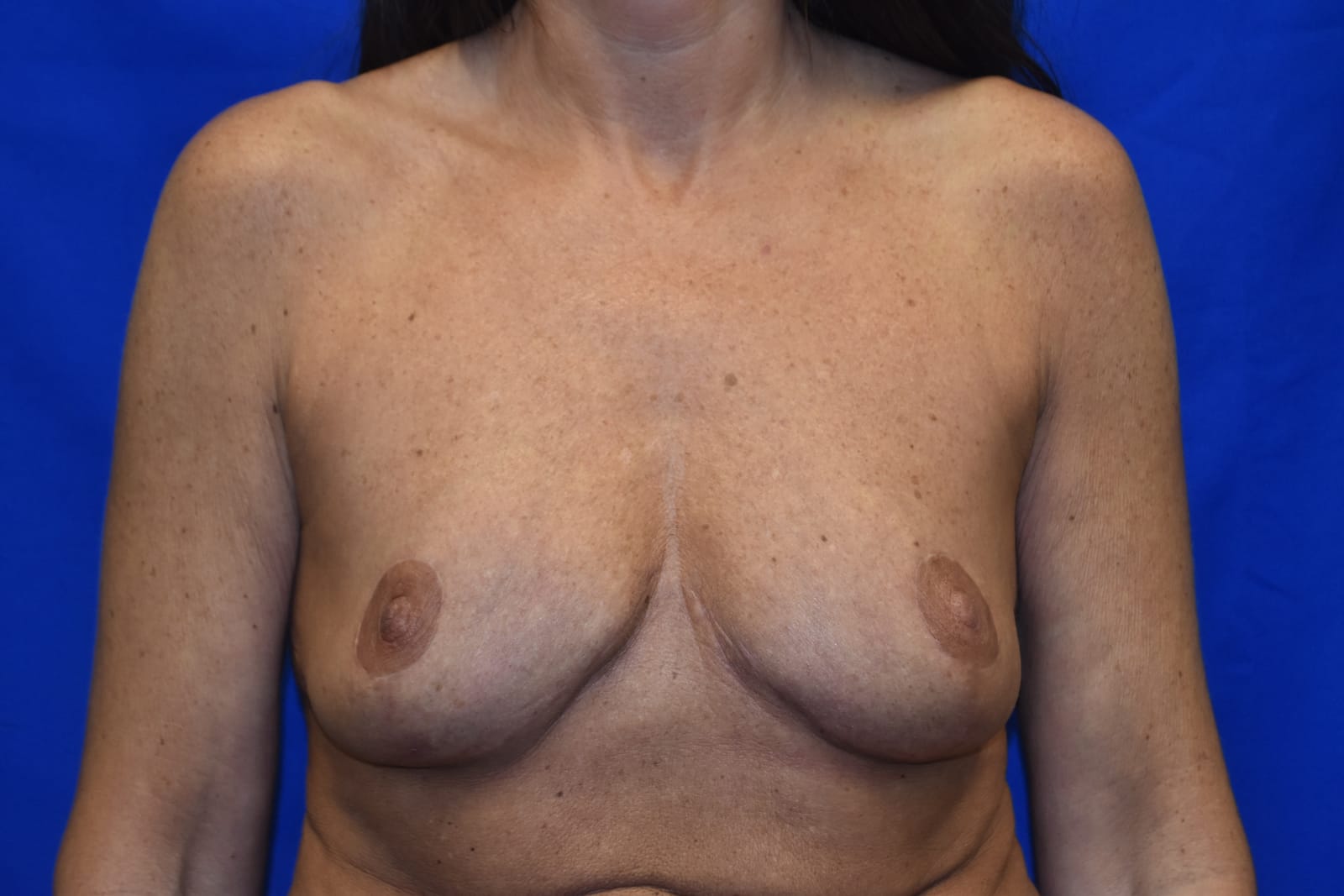 Case 3 Breast Reduction - Front view