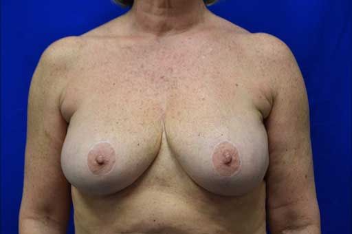 Case 4 Breast Reduction - Front view