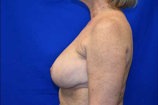 Case 4 Breast Reduction - Lateral view