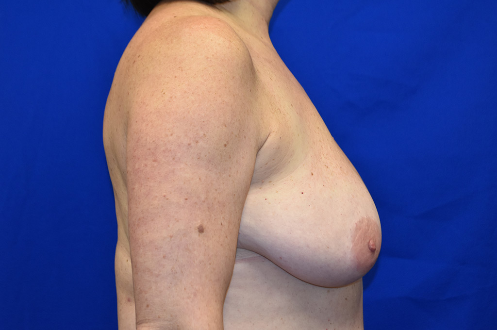 Case 5 Breast Reduction - Lateral view