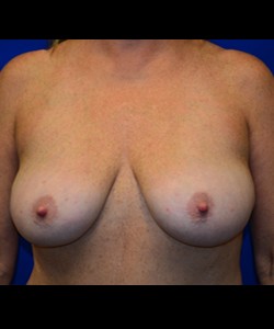 Case 6 Breast Reduction - Front view