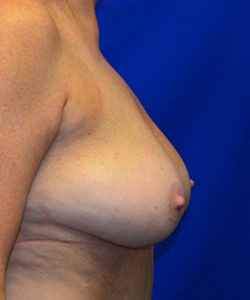 Case 6 Breast Reduction - Right lateral