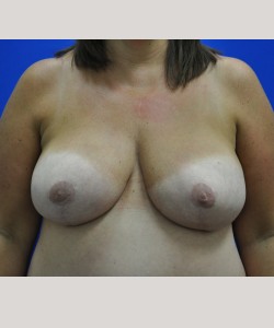 Case 7 Breast Reduction - Front view